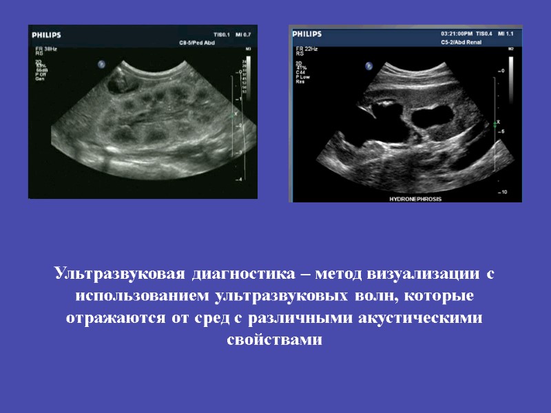 Ультразвуковая диагностика – метод визуализации с использованием ультразвуковых волн, которые отражаются от сред с